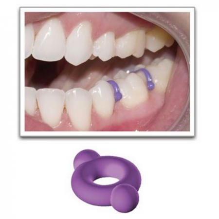 Ortho Technology Elast-O-Loop2 Separators, Purple, 960pcs/pack  #480-300