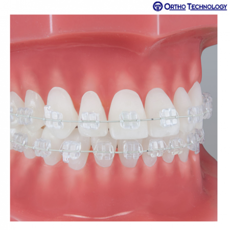 Ortho Technology Pure 018 R 5X5 SPK Upper Only