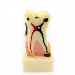 Dental Caries Tooth Model (Cross-Section)