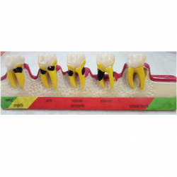 Study Model Demonstrating Gingival and Periodontal Pathologies 