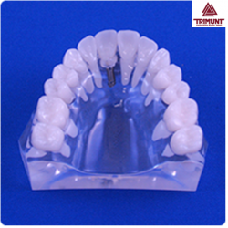 Patient Education Model For Prosthetic, C&B Model