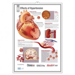 Medical Chart Design, Effects of Hyertension Poster (50x70cm) Laminated