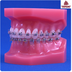 Patient Education Model For Orthodontics