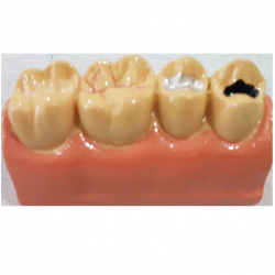 Study Model for Tooth